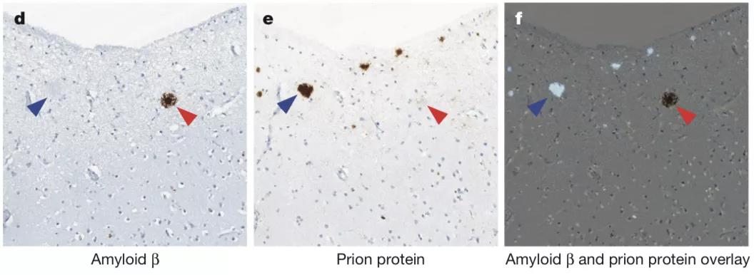 图2：伦敦大学学院（UCL）的约翰·科林奇（John Collinge）等人在克雅氏病死者脑内发现了β淀粉样蛋白斑块（红色箭头）；朊病毒斑块则以蓝色箭头标出。